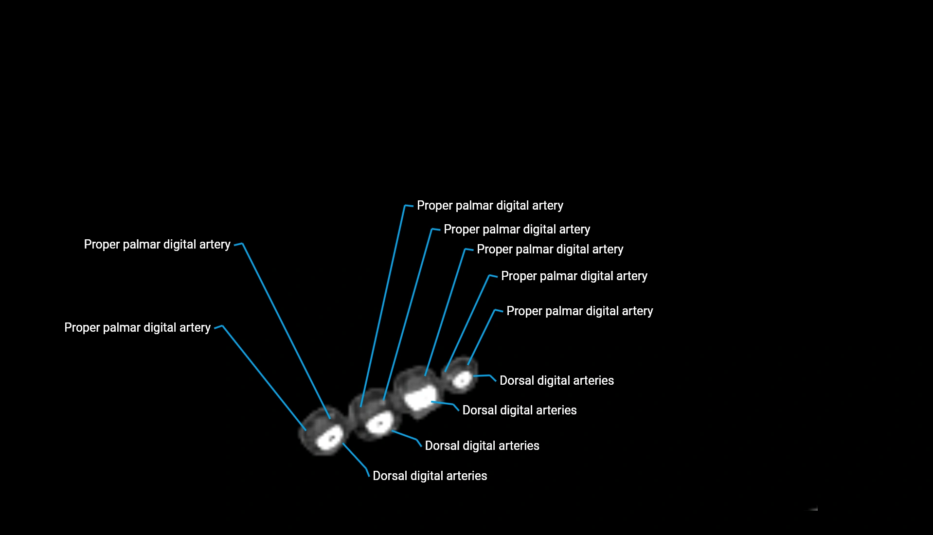 CTA upper limb axial cross sectional anatomy labelled image 29 (2).webp